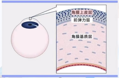 全飞秒手术-“定深爆破”是什么原理？配图1